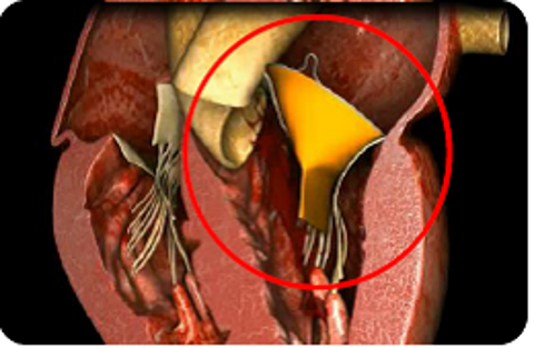 Drawing Depicting the MR Treatment Process